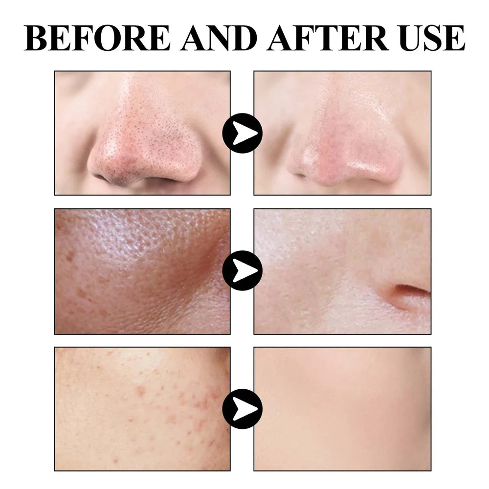 Blackhead Removal Mud Mask for Deep Pore Cleansing Care